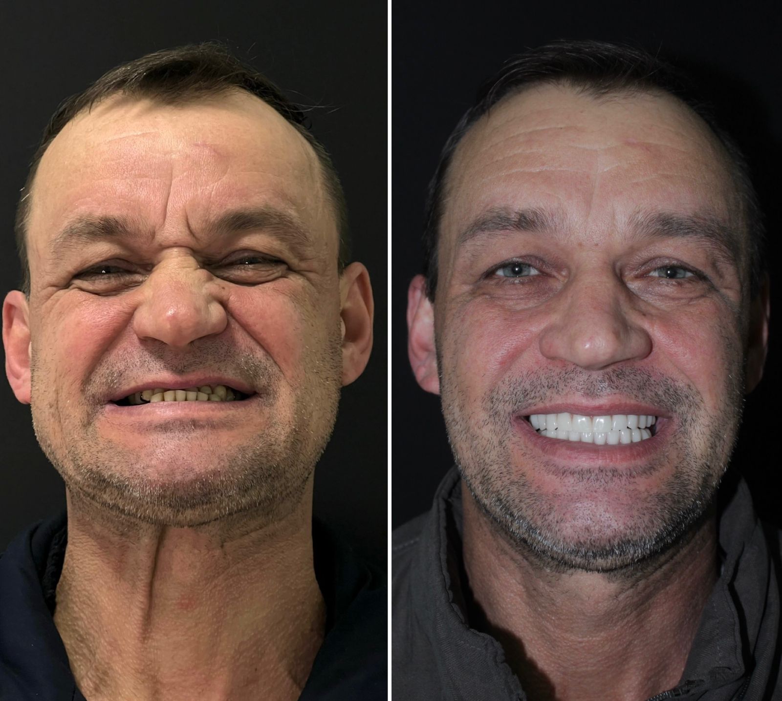 Implante dentário Brunetto Slovinscki Kayser