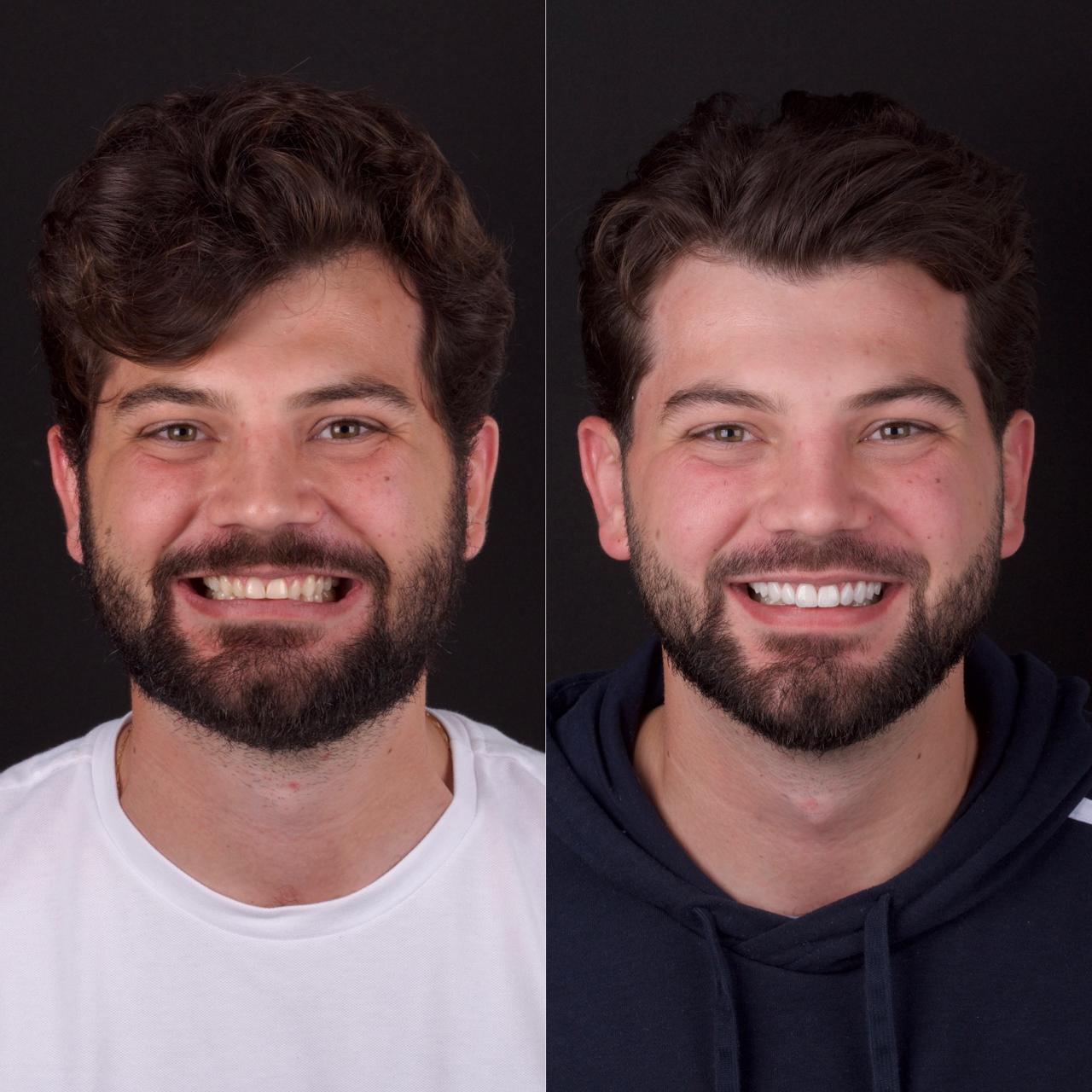 Resultado lentes dentais Brunetto Slovinscki