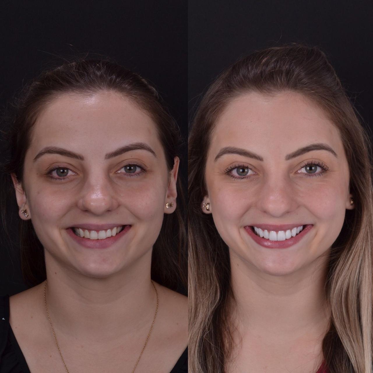 Lentes de contato dental Caxias do Sul