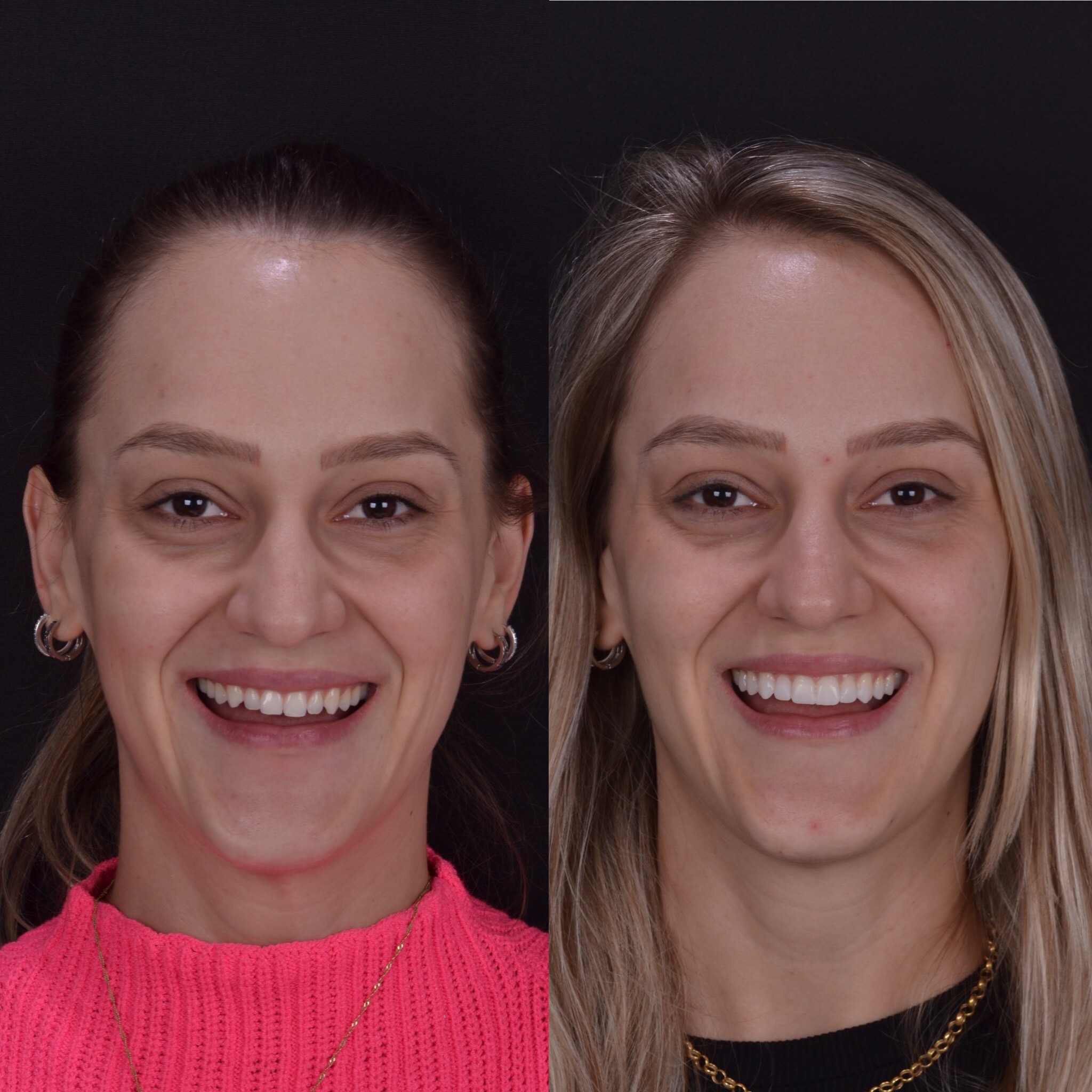 Dentista bairro Kayser lentes de contato