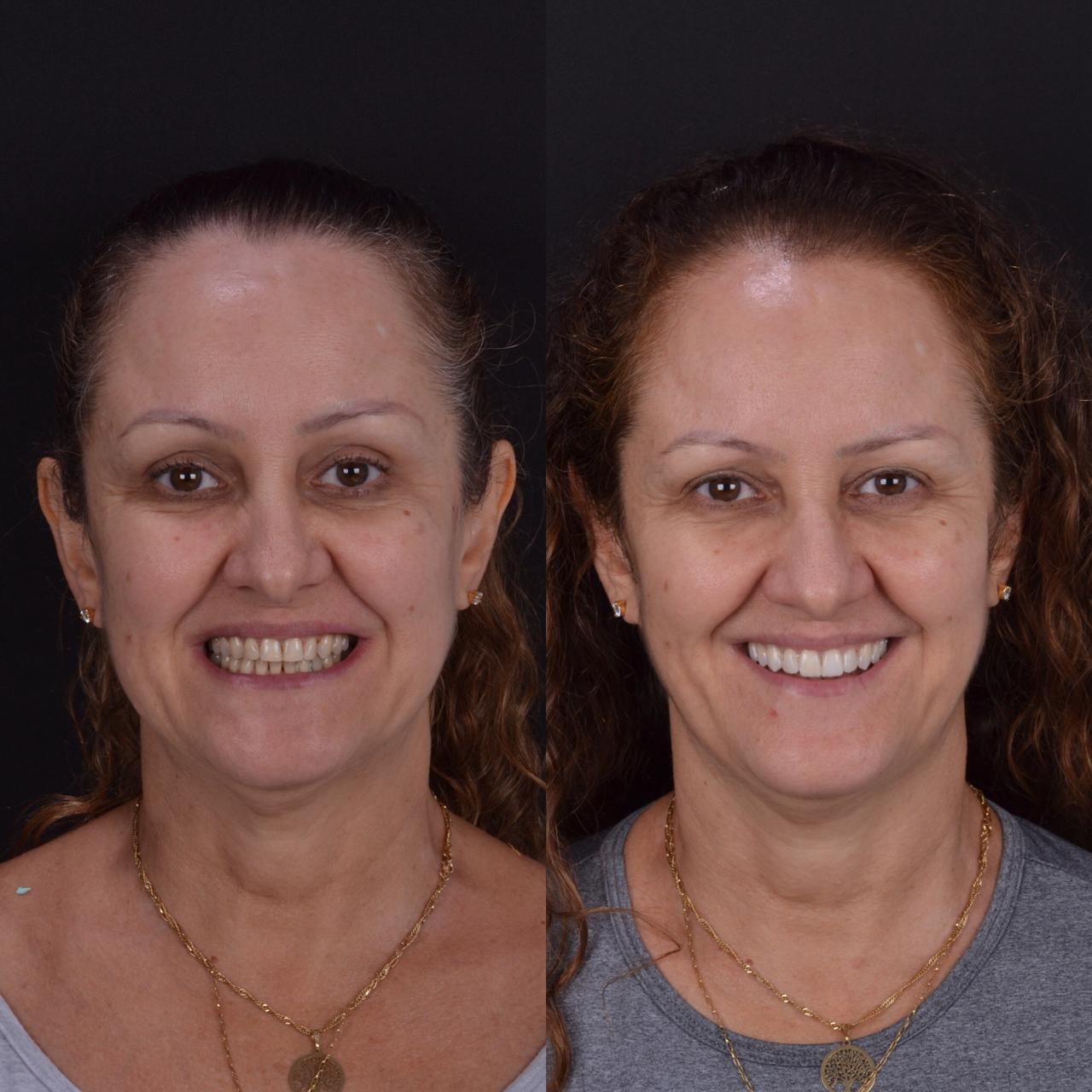 Sorriso perfeito lentes dentais Kayser