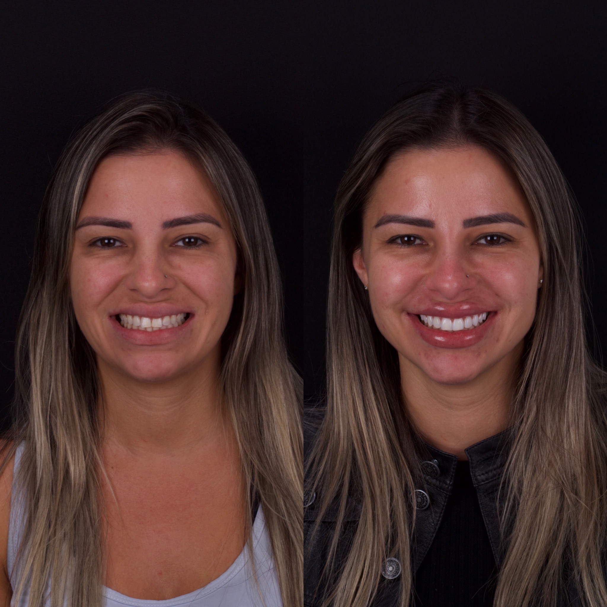 Dentista Kayser lentes dentais