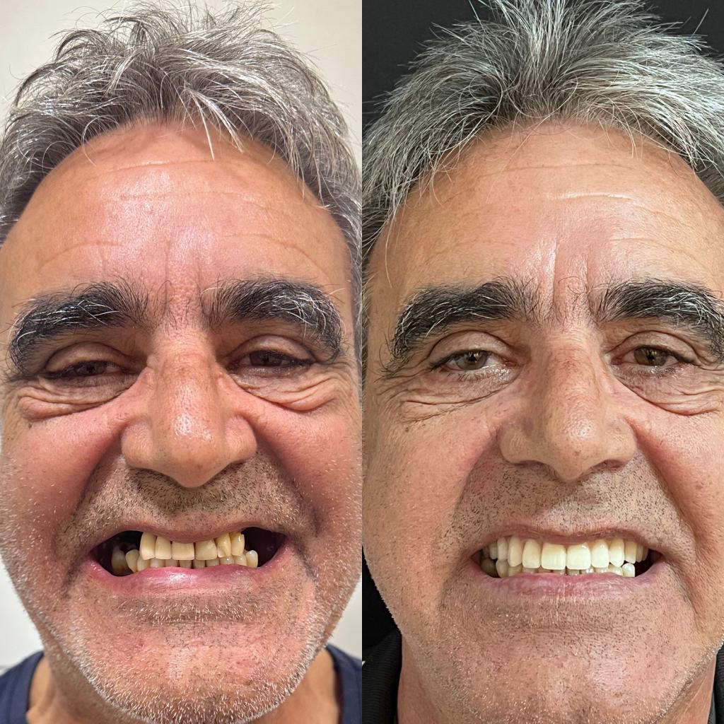 Implante dentário em Caxias do Sul