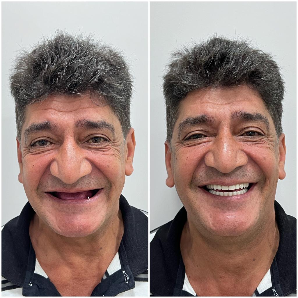 Implante no bairro Kayser Caxias do Sul