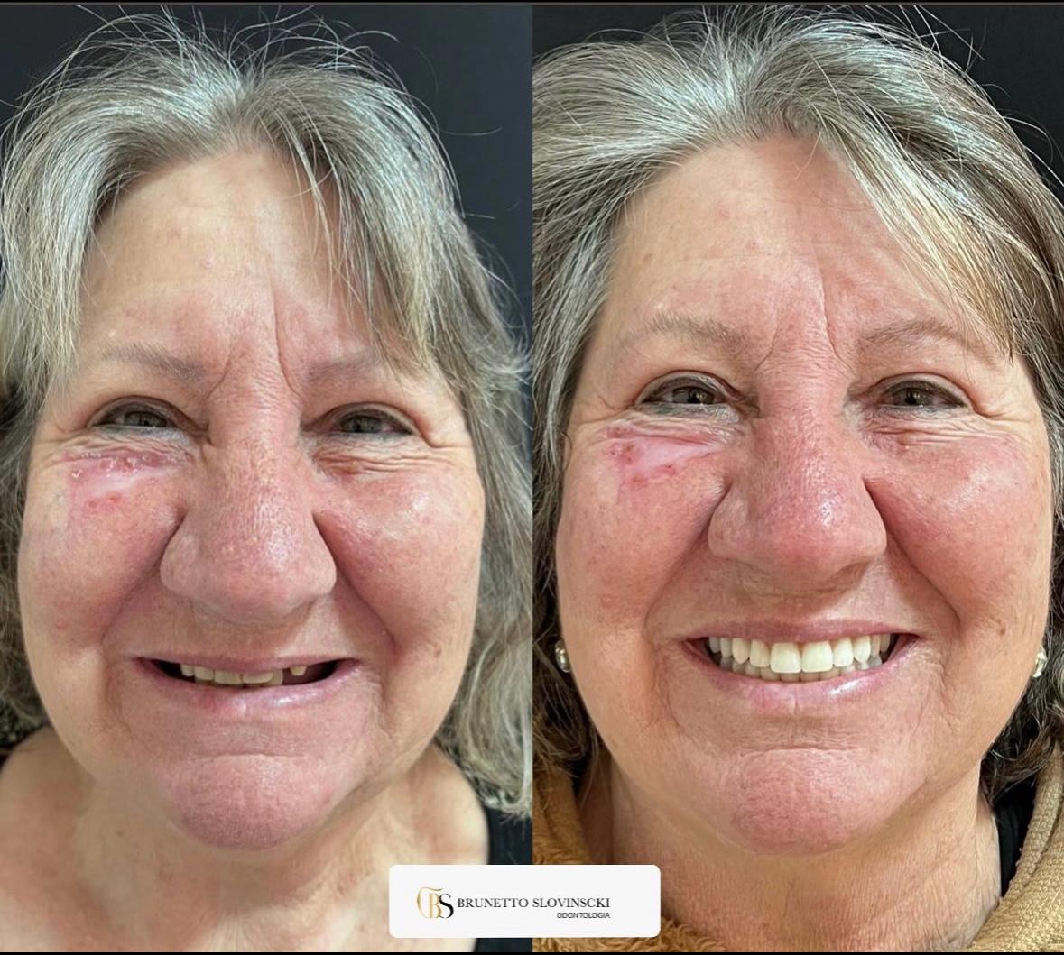 Paciente implante dentário Caxias do Sul